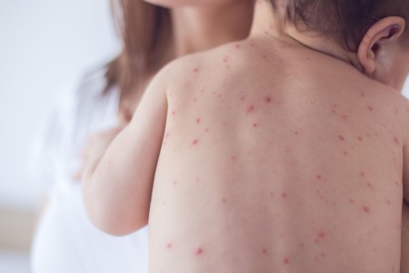 CHICKENPOX: How to take care of the skin in the 3 phases
