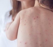 CHICKENPOX: How to take care of the skin in the 3 phases CHICKENPOX: How to take care of the skin in the 3 phases