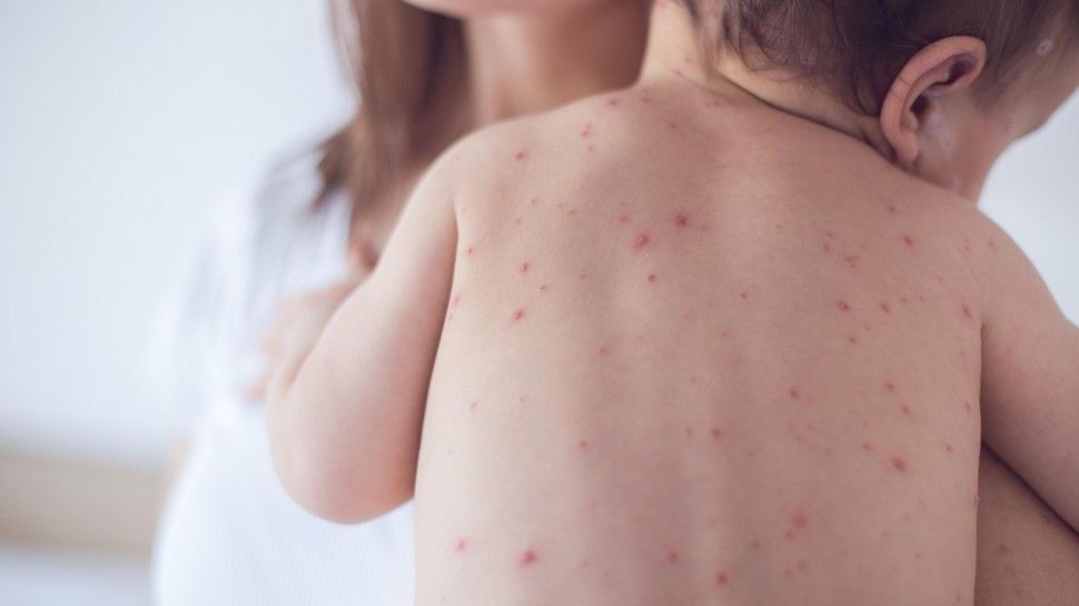 CHICKENPOX: How to take care of the skin in the 3 phases