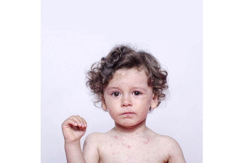 Atopic Dermatitis: What is it? How to treat?