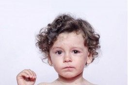 Atopic Dermatitis: What is it? How to treat? Atopic Dermatitis: What is it? How to treat?