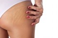 Como prevenir a forma��o de estrias e atenuar as estrias j� formadas?